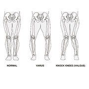 "SPARTAN" FEMOROTIBIAL BRACE FOR OSTEOARTHRITIS OF THE KNEE